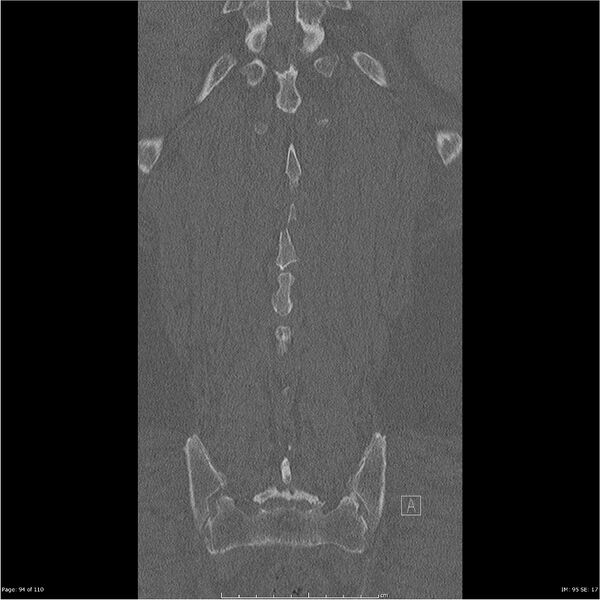 File:Cardiac trauma (Radiopaedia 32874-33858 Coronal bone window 94).jpg