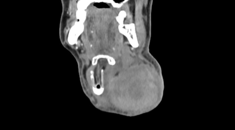 File:Carotid artery pseudoaneurysm (Radiopaedia 84030-99259 D 14).jpg