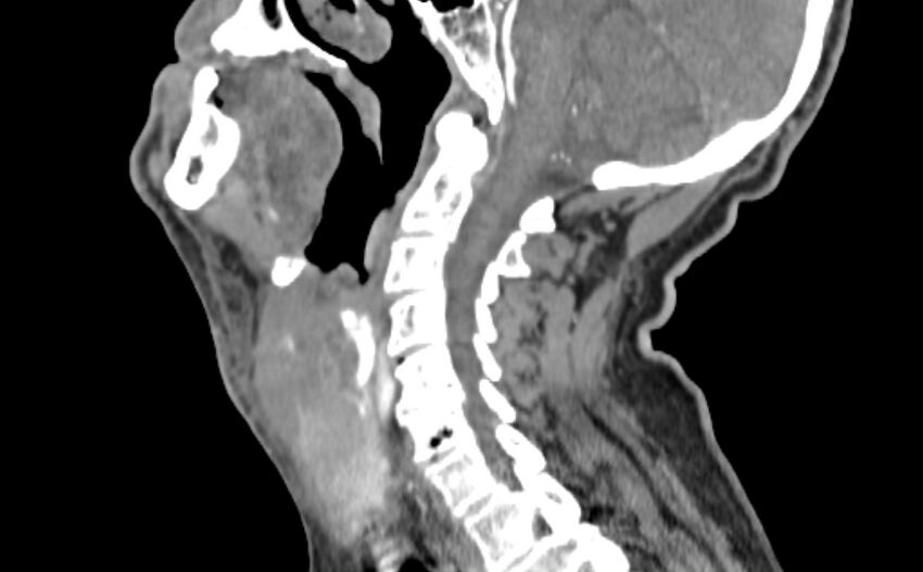 Carotid artery pseudoaneurysm (Radiopaedia 84030-99259 E 11).jpg