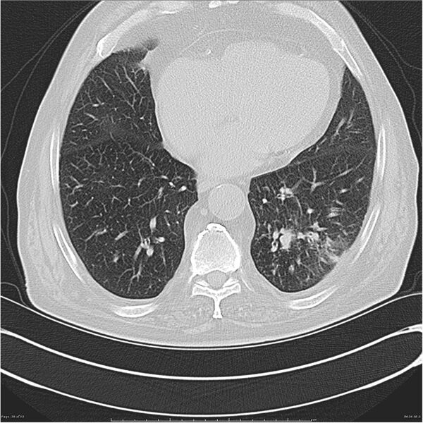 File:Cavitating left lower lobe lesion - squamous cell lung cancer (Radiopaedia 27749-28176 Axial lung window 36).jpg