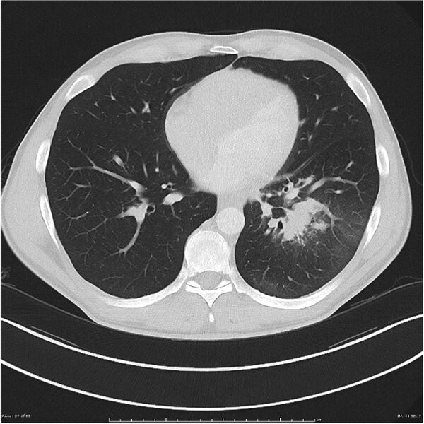 File:Cavitating lung cancer (Radiopaedia 25796-25945 Axial lung window 37).jpg