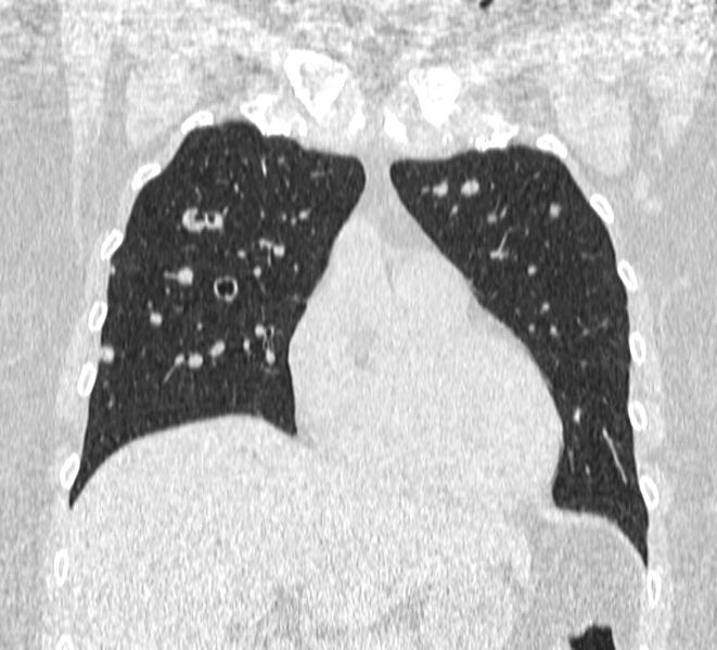File:Cavitating pulmonary metastases (Radiopaedia 17796-17555 Coronal lung window 5).jpg