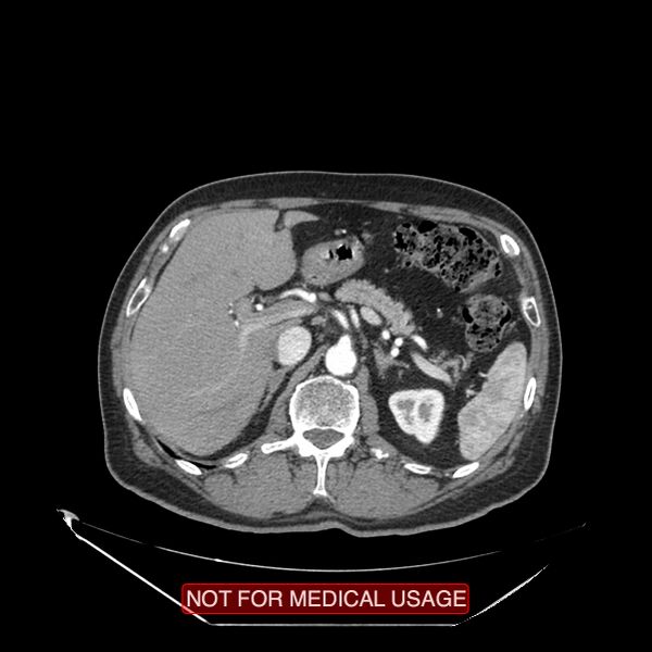 File:Celiac trunk variant anatomy - gastrohepatic trunk and splenic artery (Radiopaedia 38815-40995 A 22).jpg