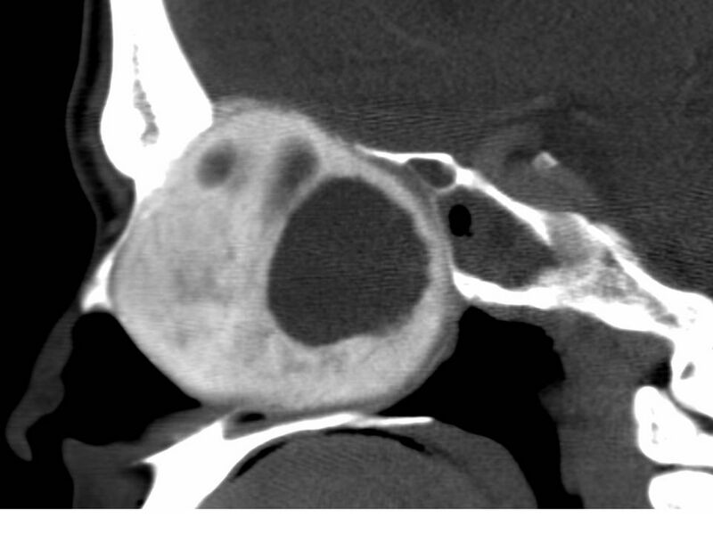 File:Cemento-ossifying fibroma (Radiopaedia 7678-8495 C 1).jpg