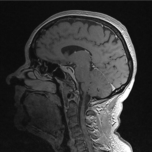 File:Central base of skull meningioma (Radiopaedia 53531-59549 Sagittal T1 C+ 16).jpg