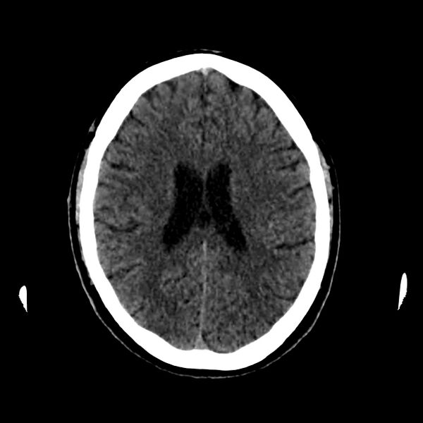 File:Central nervous system Langerhans cell histiocytosis (Radiopaedia 65728-74878 Axial non-contrast 33).jpg