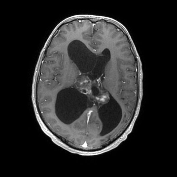 File:Central neurocytoma (Radiopaedia 67618-77021 Axial T1 C+ 16).jpg