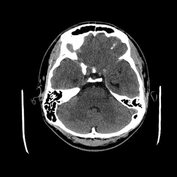 File:Central neurocytoma (Radiopaedia 79320-92379 Axial non-contrast 14).jpg
