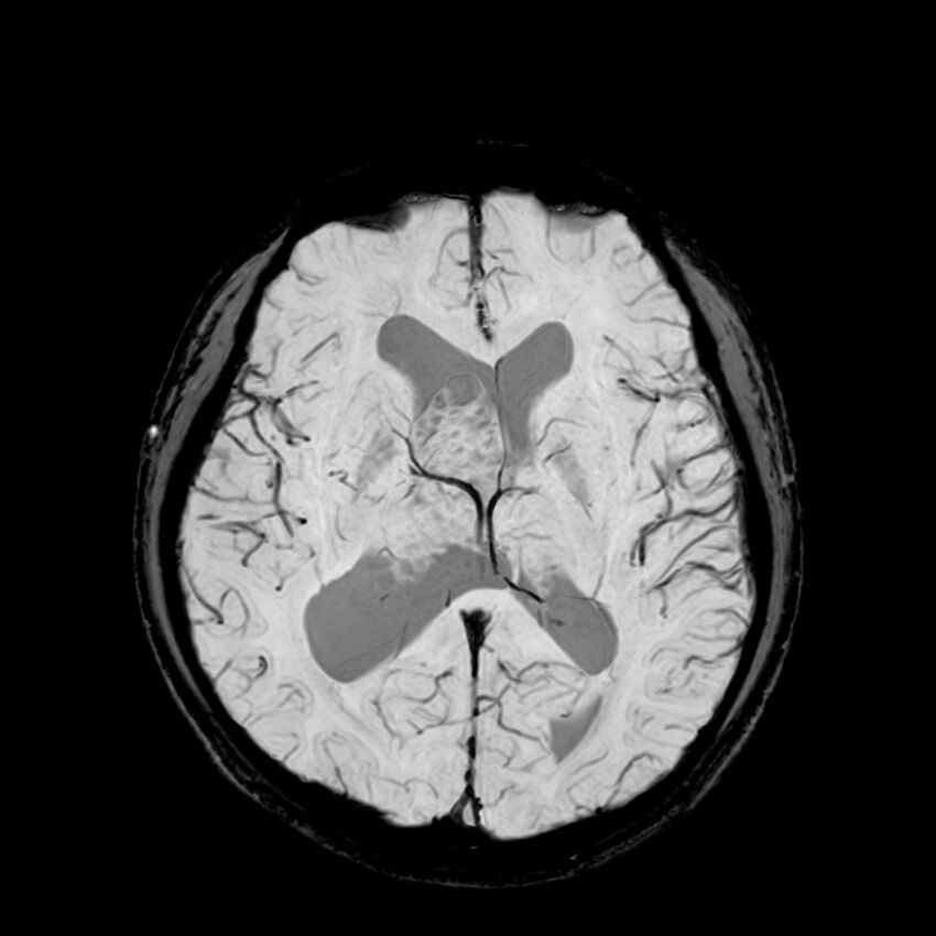 Central neurocytoma (Radiopaedia 79320-92380 Axial SWI 74).jpg