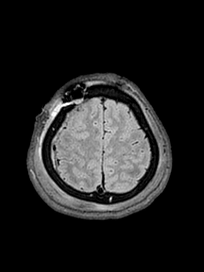 Central neurocytoma (Radiopaedia 79320-92381 Axial FLAIR 39).jpg