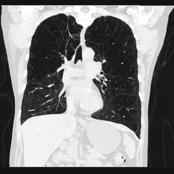 File:Centrilobular pulmonary emphysema (Radiopaedia 24495-24789 Coronal lung window 36).jpg