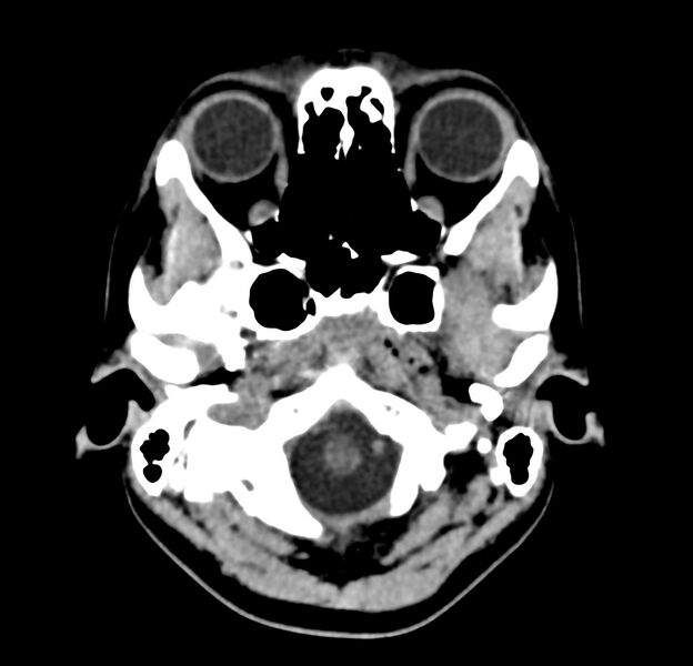 File:Cerebellar agenesis (Radiopaedia 30203-30817 Axial non-contrast 3).jpg