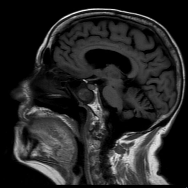 File:Cerebellar ataxia with neuropathy and vestibular areflexia syndrome (CANVAS) (Radiopaedia 74283-85159 Sagittal FLAIR 12).jpg