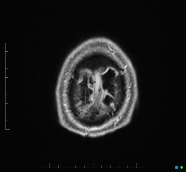 File:Cerebellar gangliocytoma (Radiopaedia 65377-74422 Axial T1 C+ 139).jpg