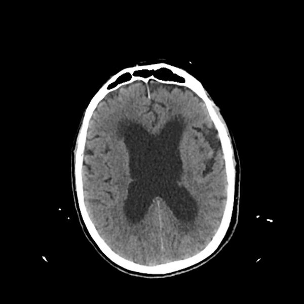 File:Cerebellar metastasis - lung tumor (Radiopaedia 69317-79145 Axial non-contrast 21).jpg