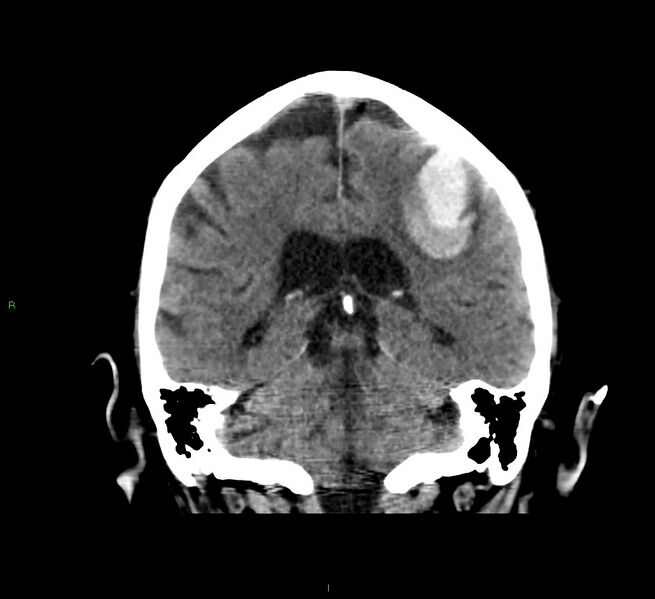 File:Cerebral amyloid angiopathy-associated lobar intracerebral hemorrhage (Radiopaedia 58376-65511 Coronal non-contrast 27).jpg