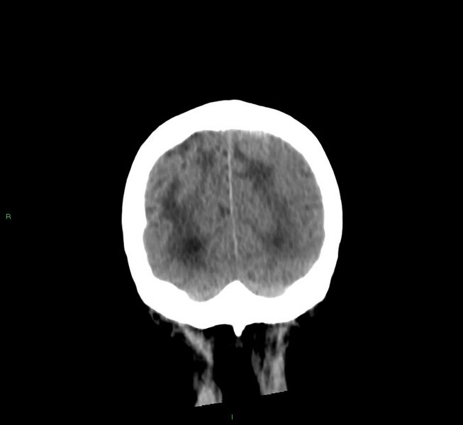 File:Cerebral amyloid angiopathy-associated lobar intracerebral hemorrhage (Radiopaedia 58530-65688 Coronal non-contrast 13).jpg