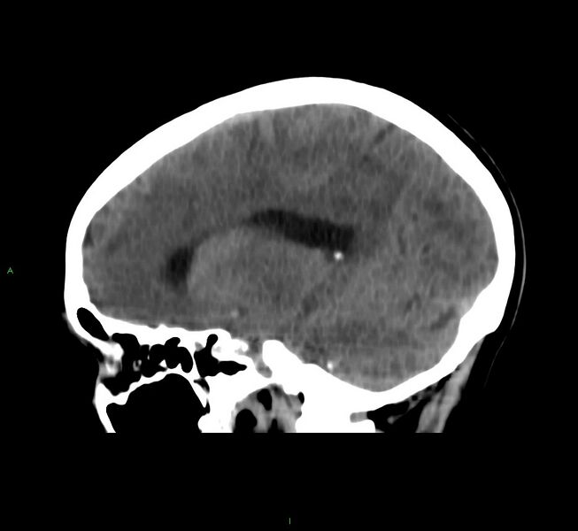 File:Cerebral amyloid angiopathy-associated lobar intracerebral hemorrhage (Radiopaedia 58566-65730 C 31).jpg