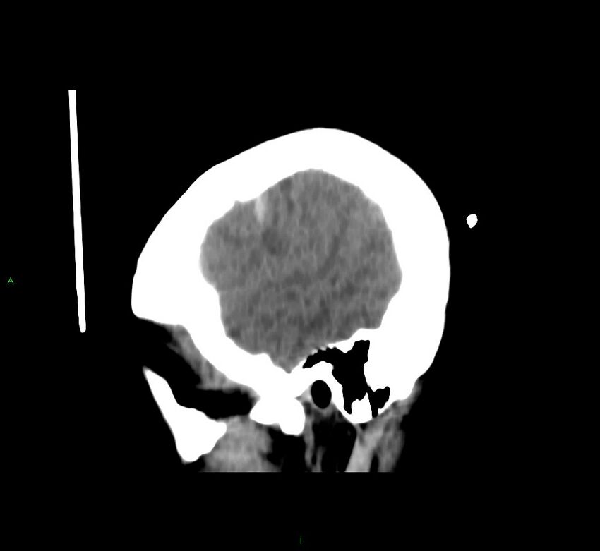 Cerebral amyloid angiopathy-associated lobar intracerebral hemorrhage (Radiopaedia 58566-65730 C 7).jpg