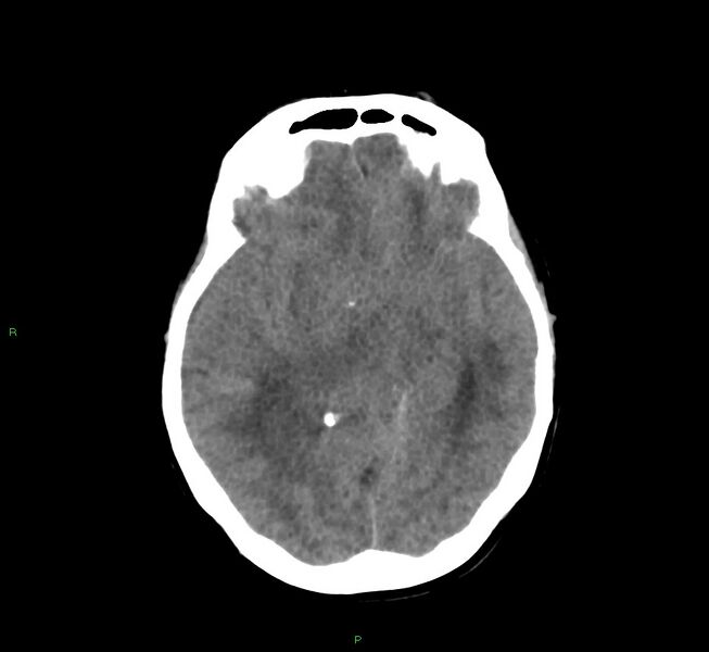 File:Cerebral amyloid angiopathy-associated lobar intracerebral hemorrhage (Radiopaedia 58751-65972 Axial non-contrast 30).jpg