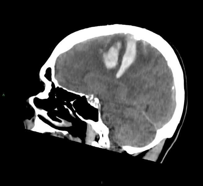 File:Cerebral amyloid angiopathy-associated lobar intracerebral hemorrhage (Radiopaedia 58756-65977 C 27).jpg