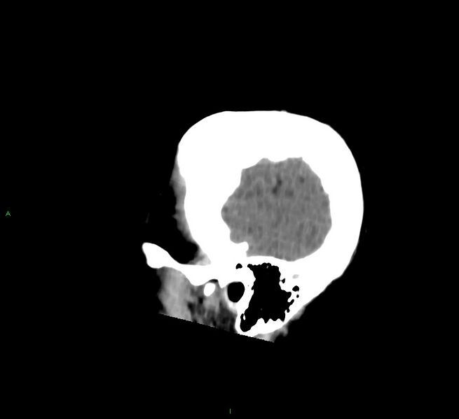 File:Cerebral amyloid angiopathy-associated lobar intracerebral hemorrhage (Radiopaedia 58756-65977 C 51).jpg