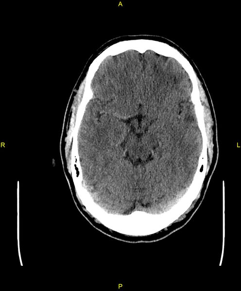 File:Cerebral autosomal dominant arteriopathy with subcortical infarcts and leukoencephalopathy (CADASIL) (Radiopaedia 86108-102051 Axial non-contrast 40).jpg