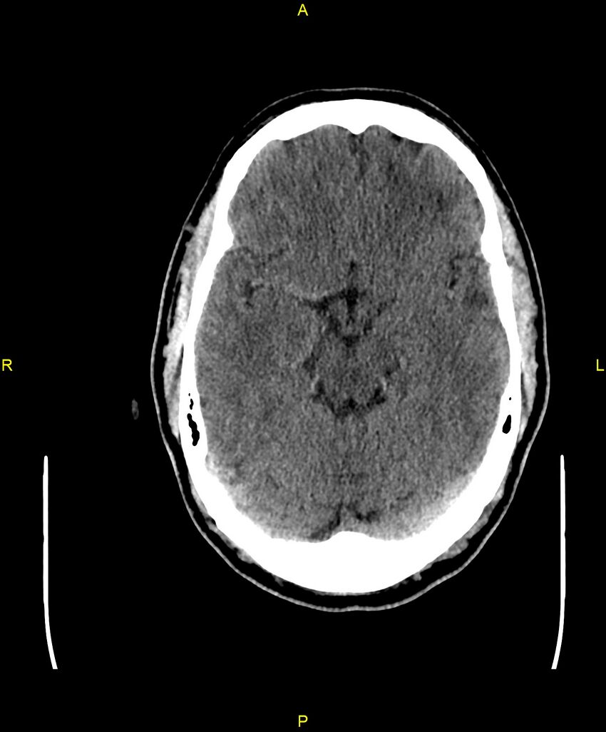 Cerebral autosomal dominant arteriopathy with subcortical infarcts and leukoencephalopathy (CADASIL) (Radiopaedia 86108-102051 Axial non-contrast 40).jpg