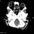 Cerebral hemorrhagic contusion with subdural and subarachnoid hemorrhage (Radiopaedia 10680-11146 Axial non-contrast 3).jpg