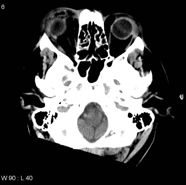 File:Cerebral hemorrhagic contusion with subdural and subarachnoid hemorrhage (Radiopaedia 10680-11146 Axial non-contrast 3).jpg