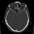 Cerebral hemorrhagic contusions (Radiopaedia 23145-23188 Axial bone window 19).jpg