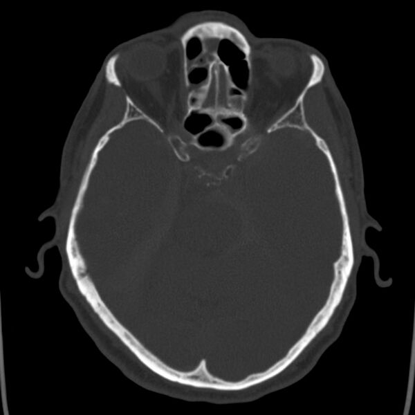 File:Cerebral hemorrhagic contusions (Radiopaedia 23145-23188 Axial bone window 19).jpg