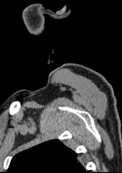 File:Cerebral hemorrhagic contusions and cervical spine fractures (Radiopaedia 32865-33841 G 2).jpg