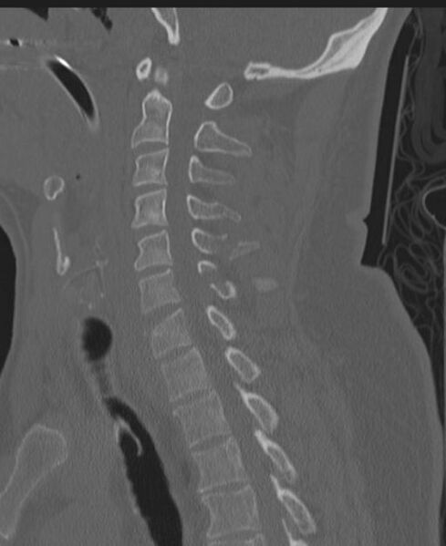 File:Cerebral hemorrhagic contusions and cervical spine fractures (Radiopaedia 32865-33841 Sagittal bone window 56).jpg