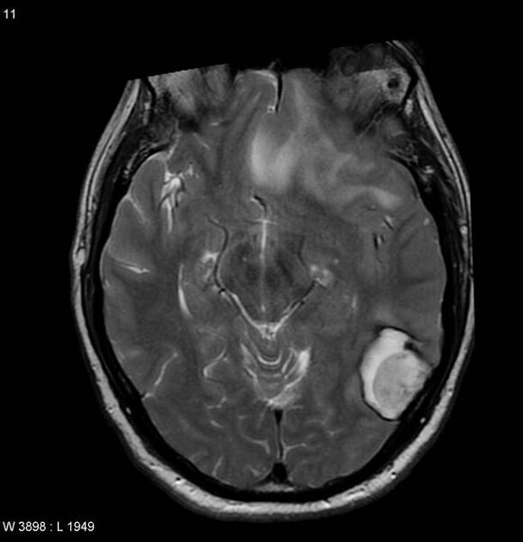 File:Cerebral metastases - renal cell carcinoma (Radiopaedia 5510-7246 Axial T2 1).jpg