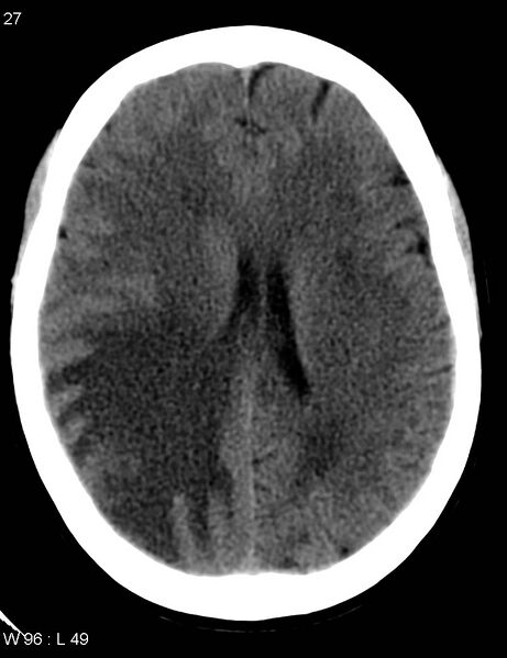 File:Cerebral metastasis - lung cancer (Radiopaedia 5315-7072 Axial non-contrast 6).jpg