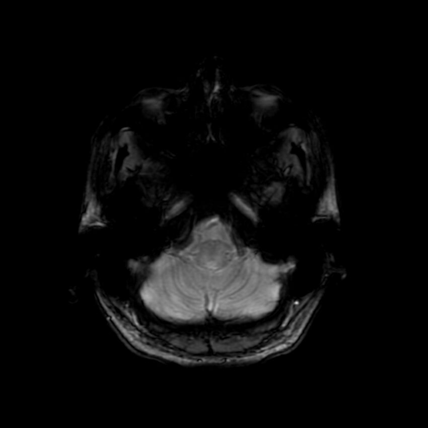 Cerebral paragonimiasis (Radiopaedia 73473-84238 Axial SWI 13).jpg