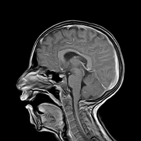 File:Cerebral tuberculoma (Radiopaedia 41152-43932 Sagittal T1 C+ 10).jpg