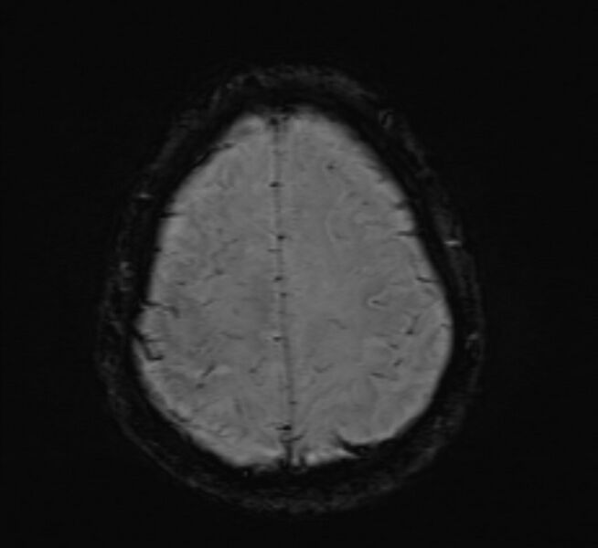 File:Cerebral venous thrombosis (Radiopaedia 71207-81504 Axial SWI 44).jpg