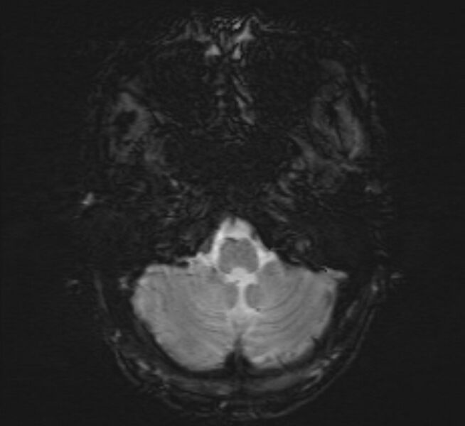 File:Cerebral venous thrombosis (Radiopaedia 71207-81504 Axial SWI 5).jpg