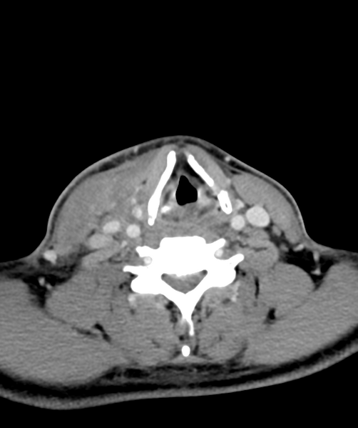 File:Cervical abscess (Radiopaedia 43725-47184 A 45).png