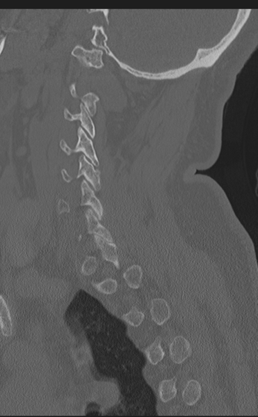 File:Cervical canal stenosis due to ossification of the posterior longitudinal ligament (Radiopaedia 47260-51823 Sagittal bone window 54).png