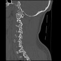 Cervical flexion teardrop fracture with cord hemorrhage (Radiopaedia 32497-33454 Sagittal bone window 33).jpg