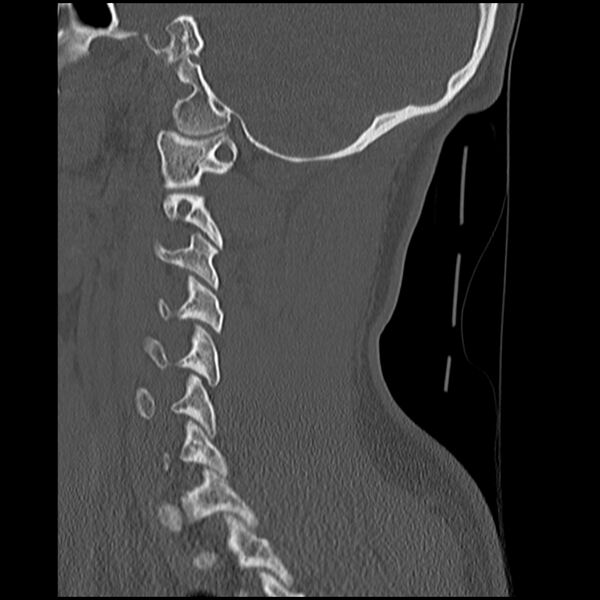 File:Cervical flexion teardrop fracture with cord hemorrhage (Radiopaedia 32497-33454 Sagittal bone window 33).jpg