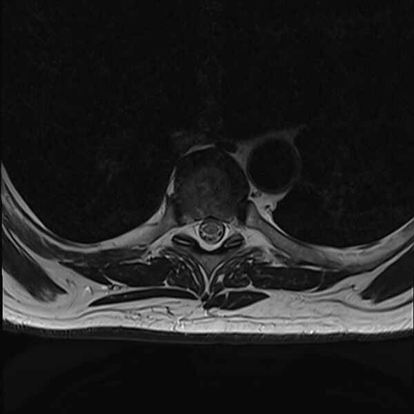 File:Cervical tumor-like myelopathy due to Type V dAVF (Radiopaedia 82461-96604 D 27).jpg