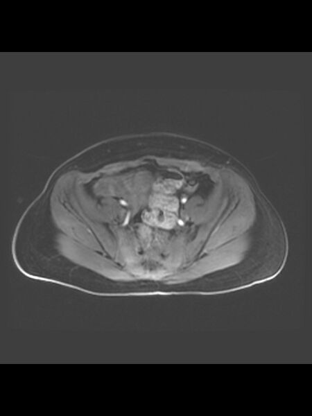 File:Cesarean section scar endometrioma (Radiopaedia 56569-63297 Axial T1 C+ fat sat 32).jpg
