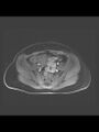 Cesarean section scar endometrioma (Radiopaedia 56569-63297 Axial T1 C+ fat sat 32).jpg