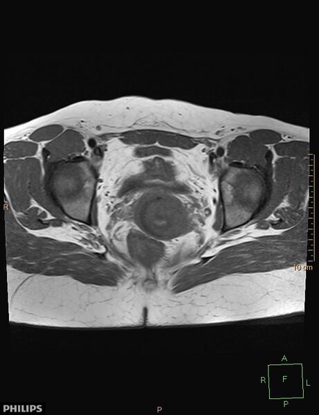 File:Cesarian scar endometriosis (Radiopaedia 68495-78066 Axial T1 17).jpg