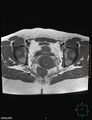 Cesarian scar endometriosis (Radiopaedia 68495-78066 Axial T1 17).jpg