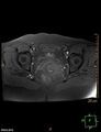 Cesarian scar endometriosis (Radiopaedia 68495-78066 Axial T1 fat sat 17).jpg